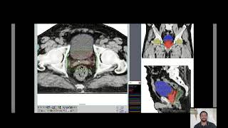 RADIOTERAPIA 2D E 3D IV  CURVAS DE ISODOSE MU E HISTOGRAMA DOSE VOLUME [upl. by Drolyag]