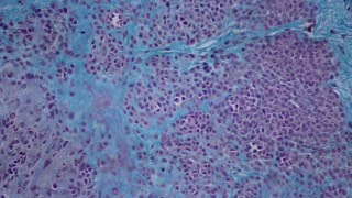 006 Intradermal nevus Histology HEA50 stain [upl. by Enitsua]