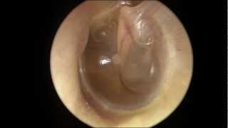 Serous Otitis Media [upl. by Best]