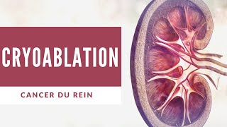 Cryoablation Cancer rénal sans Chirurgie par Radiologie Interventionnelle [upl. by Kaden459]