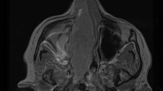 Sinonasal Squamous Cell Carcinoma [upl. by Sueaddaht128]