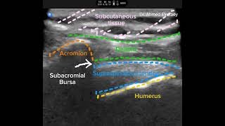 Subacromial bursa injection [upl. by Nekcarb]