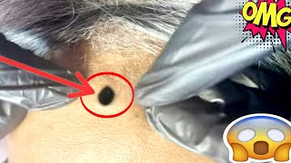 blackheads extractions  blackheads extractions [upl. by Adolphe]