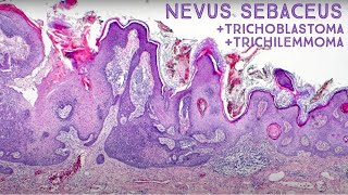 Tumors Growing from Nevus Sebaceus Trichilemmoma amp Trichoblastoma Dermpath in 5 Minutes [upl. by Lerner]