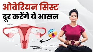 ओवेरियन सिस्ट की समस्या दूर करेंगे ये आसन  Cure Ovarian Cyst [upl. by Putscher274]