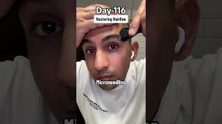 Day116 of Applying Minoxidil Everyday haircare hairloss minoxidil [upl. by Inna]