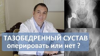 Операция тазобедренного сустава делать или нет Эндопротезирование [upl. by Fidel306]