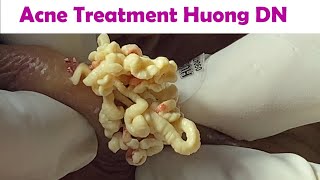 Acne Treatment Huong Da Nang  2024 Acne Huong 715 [upl. by Shimberg]