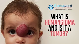 What is hemangioma and is it a tumor  All you need to know  Dr Rohit Batra Explains [upl. by Leake]