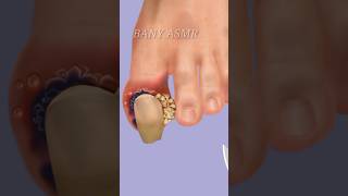 ASMR Screw nail Toenail Removal Animation Treatment shortsfeed toenailbanyasmrasmrytshorts [upl. by Sibeal146]