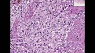 Histopathology Skin Malignant melanom [upl. by Oihsoy965]