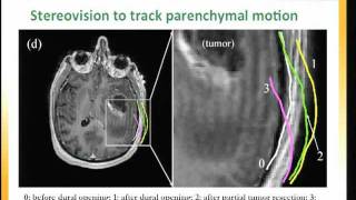 Integration of 3D intraoperative ultrasound for enhanced neuronavigation [upl. by Emera]