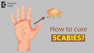 How to cure Scabies  Dr Rajdeep Mysore [upl. by Vasiliki]