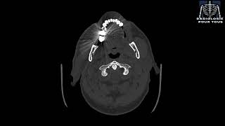 SCANNER DES SINUS Rhinite chronique avec sinusalgies [upl. by Artemahs133]