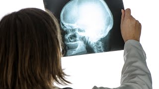 Le traumatisme craniocérébral une blessure sournoise [upl. by Warden]