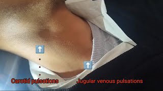 Jugular Venous Pressure JVP Examination [upl. by Ienttirb]