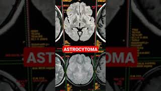 Imaging Tumors  Astrocytoma [upl. by Hareehat]