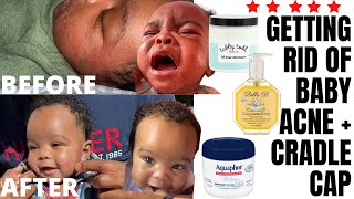 HOW TO GET RID OF CRADLE CAP 3 month old routine [upl. by Schulze]