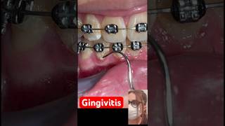 Gingivitis Braces Orthodontics treatments [upl. by Nadbus820]