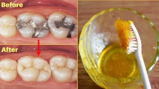 एक बार में दांत का कीड़ा और दर्द बाहर निकालने का बेहतरीन उपाय  How To Get Rid Of Tooth Cavity [upl. by Atekehs]