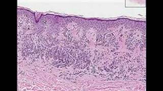 Histopathology SkinCompound Clarks nevus dysplastic nevus [upl. by Denoting]