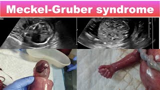 Meckel Gruber syndrome I Ultrasound [upl. by Nyleda]