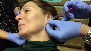 Juvederm Volbella Injection for Ear Lobe Rejuvenation [upl. by Eddana8]