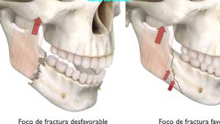 Fracturas Mandibulares [upl. by Mcconaghy306]