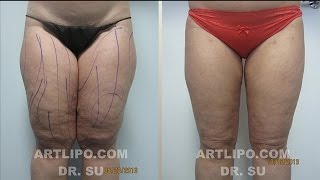 Laser Liposuction [upl. by Nylirehs]