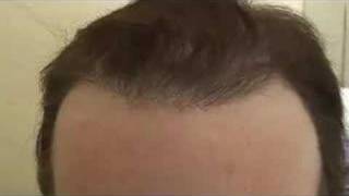 Dr Ray Woods Body Hair Transplant [upl. by Arikaahs616]