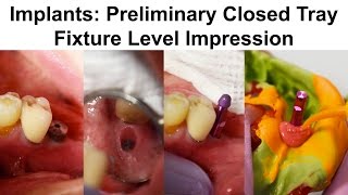 3 Implants Preliminary Closed Tray Fixture Level Impression [upl. by Sabra]