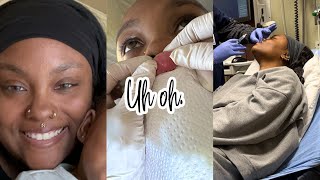 getting my embedded medusa piercing removed 😳 [upl. by Lucie]