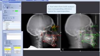 Making superimposition of two analyses in Planmeca Romexis® Cephalometric Analysis module [upl. by Tirza]