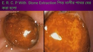 E R C P With Stone Extraction ইআরছিপি পিত্ত নালীর পাথর বের করা হলো l l Endo Cut [upl. by Lienaj]