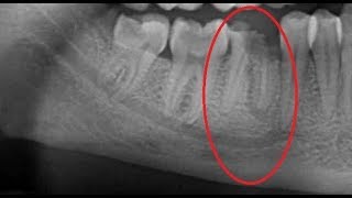 Extraction of infected root canal treated lower molar [upl. by Eedoj478]