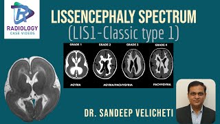 Lissencephaly SpectrumClassic Type1Sandeep VelichetIunderstanding lissencephaly microscopic level [upl. by Loggins675]