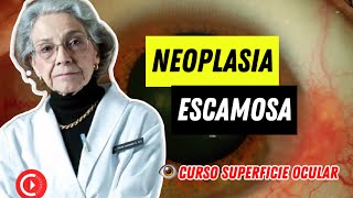 CURSO SUPERFICIE OCULAR ➡️ NEOPLASIA ESCAMOSA Dra Carmen Barraquer [upl. by Nyrhtak]