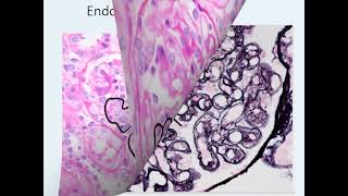 شرح عربي Membranoproliferative Glomerulonephritis Practical session [upl. by Ennailuj728]