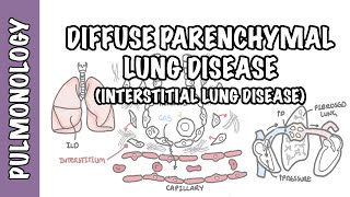 Interstitial Lung Disease ILD  Classification pathophysiology signs and symptoms [upl. by Sylvie]