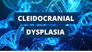 Cleidocranial Dysplasia Introduction Etiology Clinical Features and Treatment [upl. by Antin]