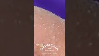 NOSE BLACK heads Tweezers Removal  Satisfying blackheads extraction Shorts 2 [upl. by Eahsat897]