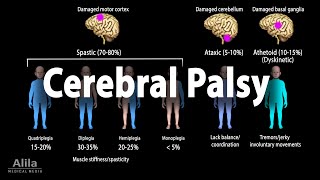 Cerebral Palsy Animation [upl. by Porta]