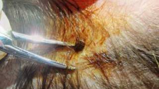 How To Remove a Tick in the ER [upl. by Amikay]