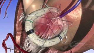 Mitral Heart Valve Ring  Medical amp Scientific Video Production [upl. by Anilahs]