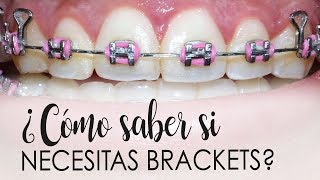 ¿CÓMO SABES SI NECESITAS BRACKETS  CASOS QUE NECESITAN ORTODONCIA [upl. by Guild532]