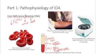 Part 1 of 3 Pathophysiology of Iron Deficiency Anemia Khan Academy NCLEXRN [upl. by Niawtna]