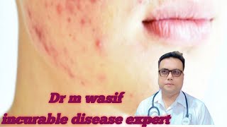 acne vulgaris dermatology acne vulgaris treatment at home [upl. by Nomis25]