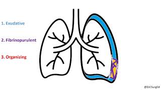 Empyema and Pleural Effusions [upl. by Appel460]