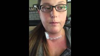 Thyroidectomy Surgery Recovery [upl. by Nylecoj398]