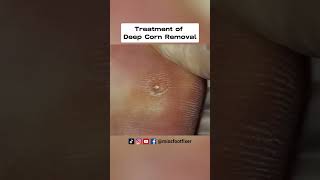 My Way of Working At Home  Deep Corn Removal At home  Full treatment by Miss Foot Fixer [upl. by Karmen]